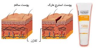 کرم رفع ترک های پوستی ناشی از  بارداری و چاقی و لاغری گاتیو ایتالیا 100 میل